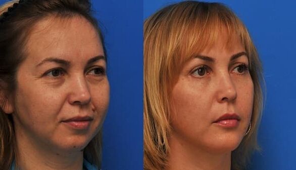 vor und nach Hautverjüngung mit Straffung Foto 1