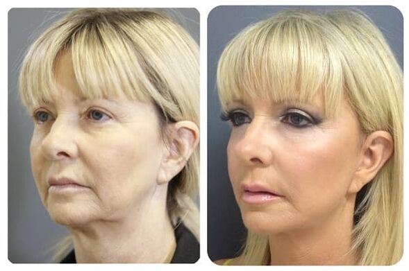vor und nach Hautverjüngung mit Straffung Foto 2