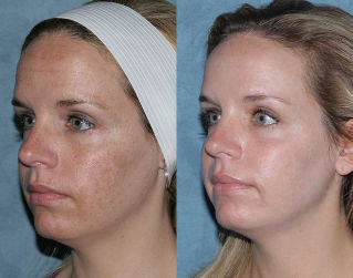 Fotos vor und nach der fraktionierten Gesichtsverjüngung